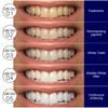 7Pcs/14Pcs Teeth Whitening Stripes Bright White Tooth Sticker Oral Hygiene Care Non Sensetive Effective Coffee Tea Stains Clean
