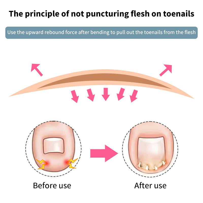 1 шт. Устройство для коррекции вросшего ногтя – Невидимый эластичный выпрямляющий зажим для выравнивания ногтя и ухода за педикюром