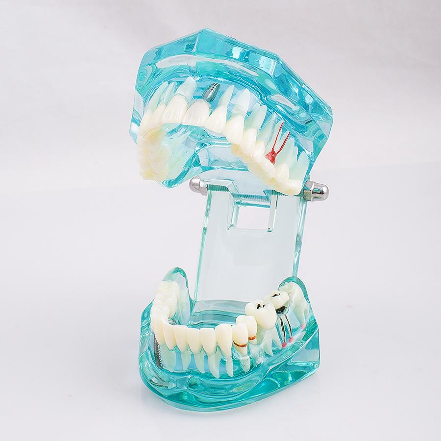 Dental Study Tooth Transparent Adult Pathological Teeth Model