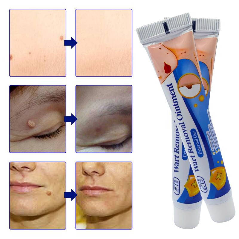 Мазь для удаления родинок ZB с коллагеном для ежедневного ухода за кожей и растворения бородавок