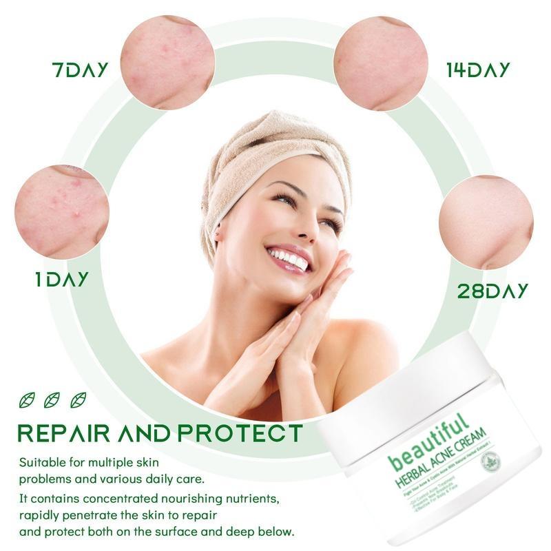 Acne Removing Cream, Acne Removing, Male and Female Students Fade Acne Marks, Acne Scar Removing Cream, Acne Pit Repairing