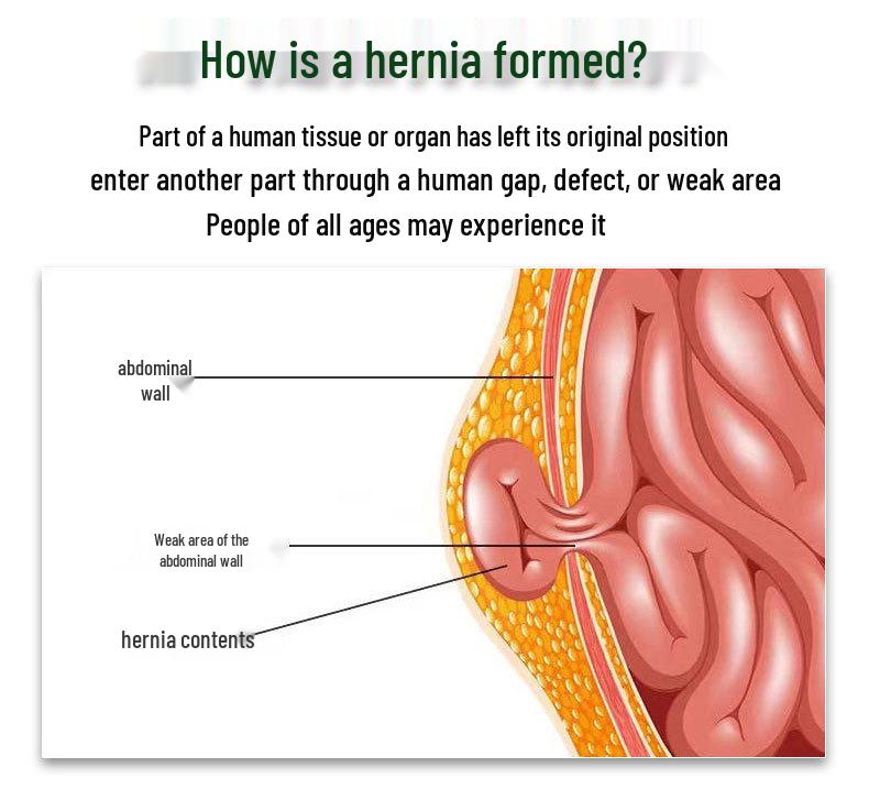 Двусторонний паховый бандаж для взрослых - Косая поддержка и защита тонкого кишечника