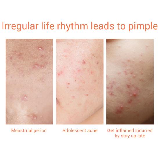 2 Packs Tea Tree Oil Day Night Acne Pimple Remover Patches Skin Care Treatment