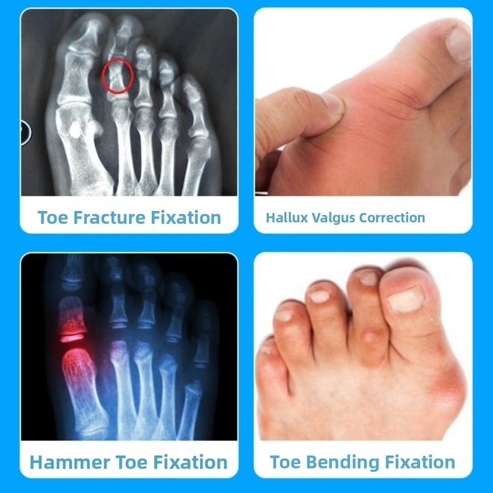 Adjustable Bunion Corrector Band Metal Reinforcement Foot Correction Brace  Outdoor