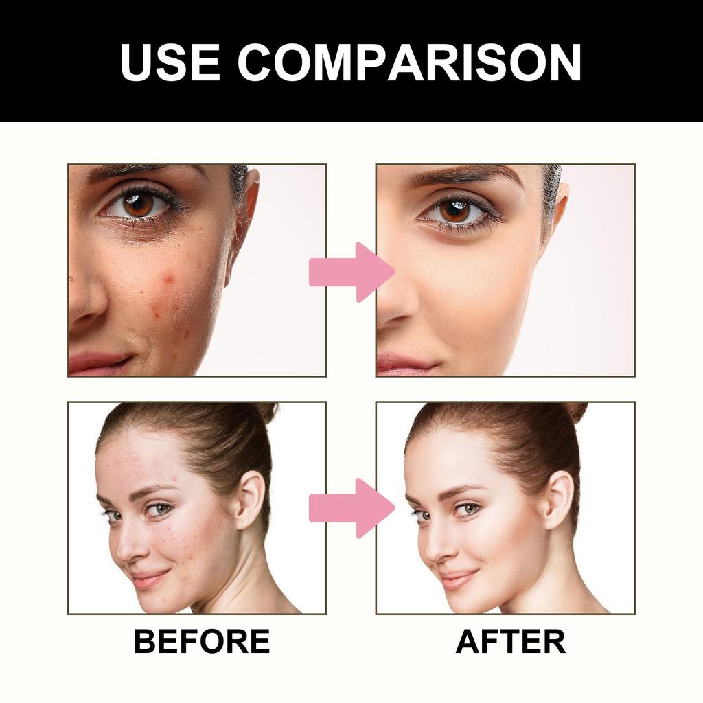 Cute Black Acne Patches For Face,Reduce Acne, Close Acne Marks, And Remove Blackheads(108 Count)