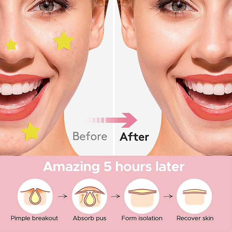 Набор гидроколлоидных пластырей от акне с 600 пластырями в форме звезд и сердец для дневного использования