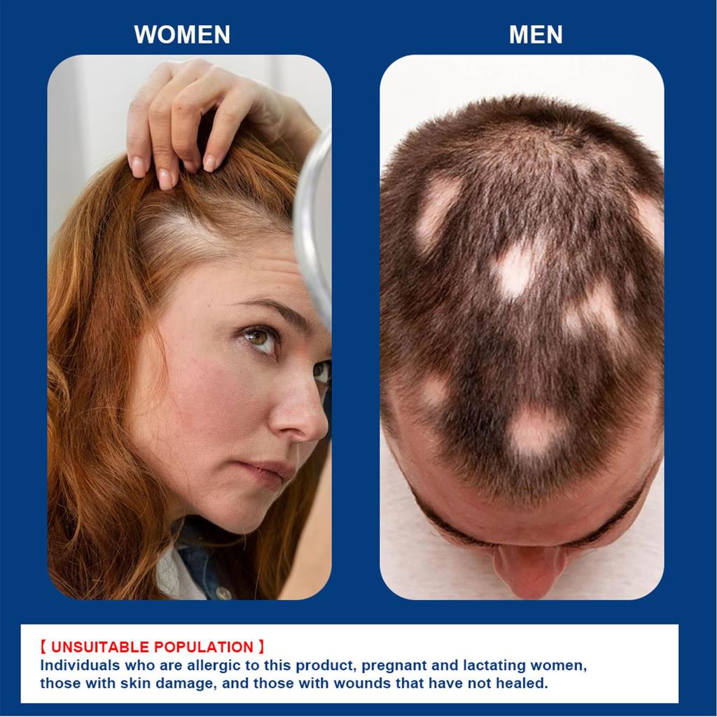 Крем от очаговой алопеции, устраняет выпадение волос, активизирует волосяные фолликулы, способствует росту