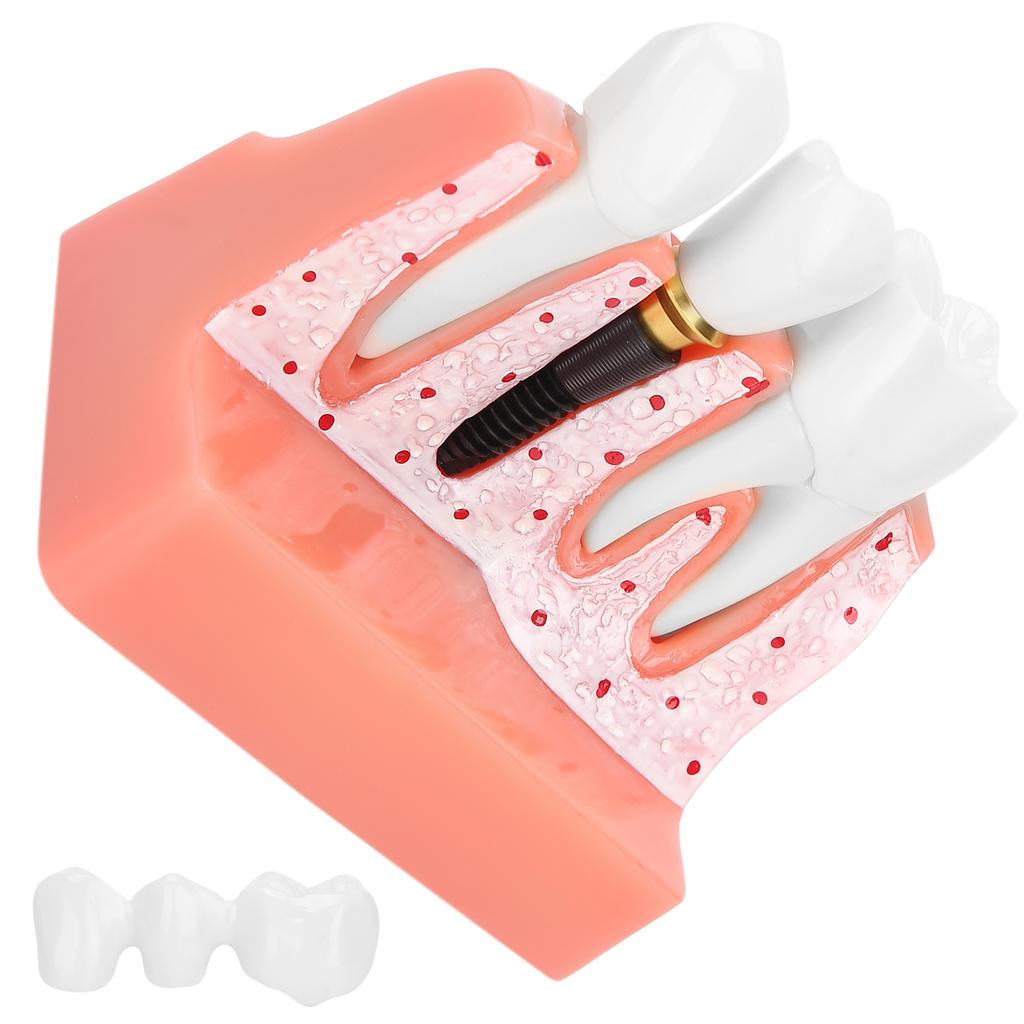 Модель зубов Анализ зубного имплантата Модель короночного моста Демонстрационная модель зуба