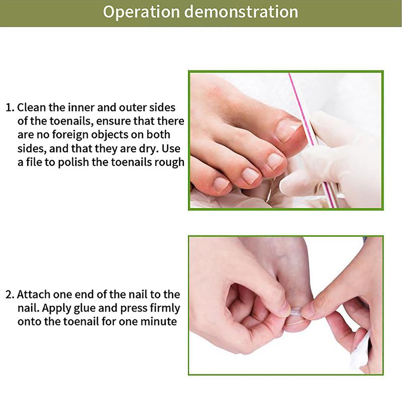 10 шт., коррекция вросшего ногтя, выпрямляющий зажим для педикюра