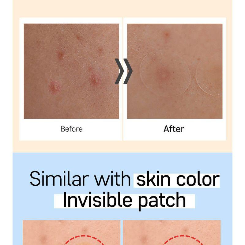 G9SKIN Пластырь-патч Zero Solution Spot Cover 108 шт.