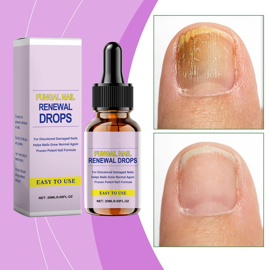 Nail Nutrient Solution;  Nail Care,Quickly Remove Discolored Nails; Effectively Soften Thick Nails; Strengthen Nail Bed Structure,1pc,20ml