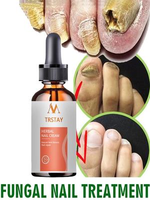 Спрей для ремонта грибковых ногтей, уход за больными, гель для удаления грибка ногтей на ногах, противоинфекционный уход за паронихией, онихомикозом