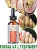 Fungal Nail Repair Spray Nursing Treatment Foot Nail Fungus Removal Gel Anti-Infective Paronychia Onychomycosis Care
