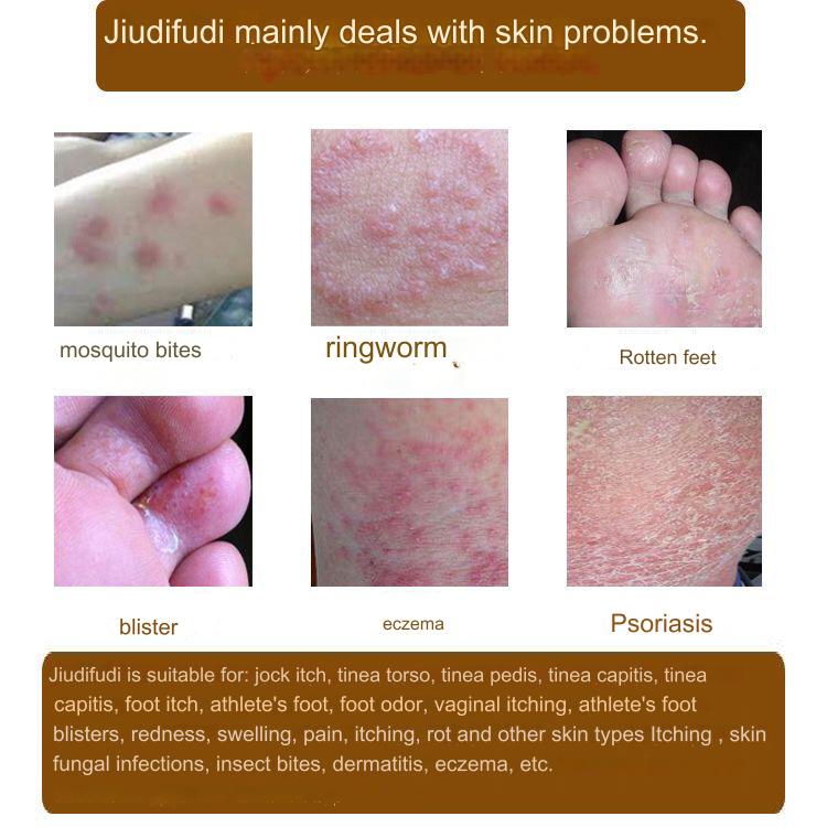 Травяной крем против укусов комаров и зуда кожи, местный крем против зуда