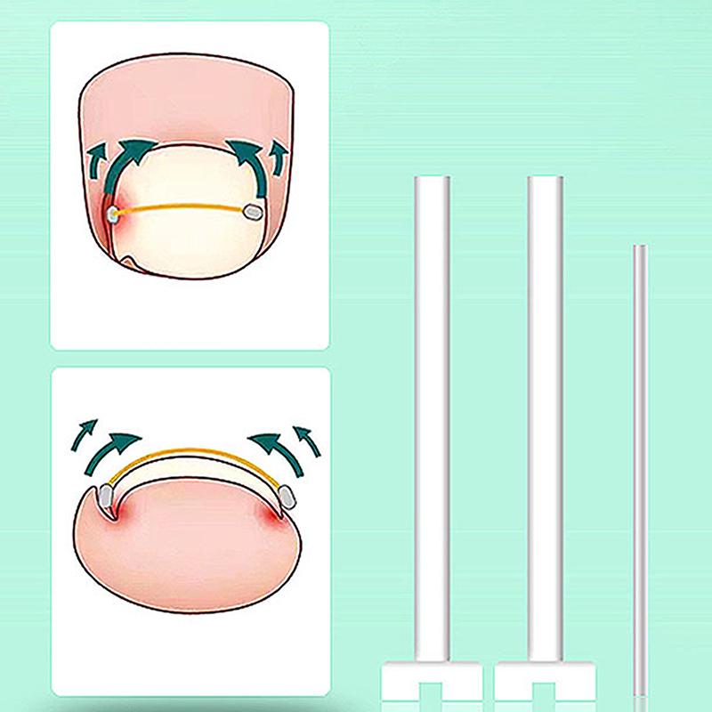 Корректор вросших ногтей, инструменты для педикюра, восстановление, лечение ногтей на ногах, профессиональный зажим для выпрямления вросших ногтей, скобка