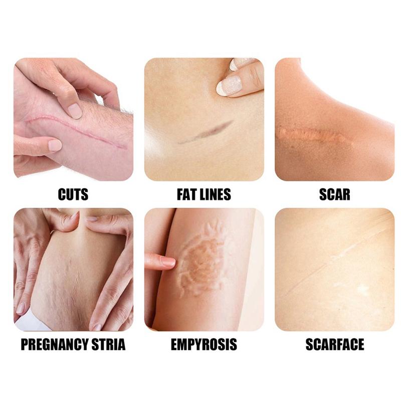 Хирургическое удаление шрамов, наклейка, пластырь, силиконовый гель, эффективное лечение шрамов