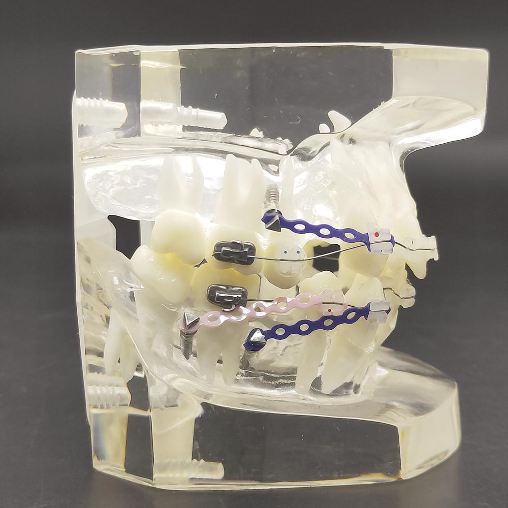 1 шт., прозрачная стоматологическая ортодонтическая модель прикуса с брекетами, буккальная трубка дуги для общения с пациентом