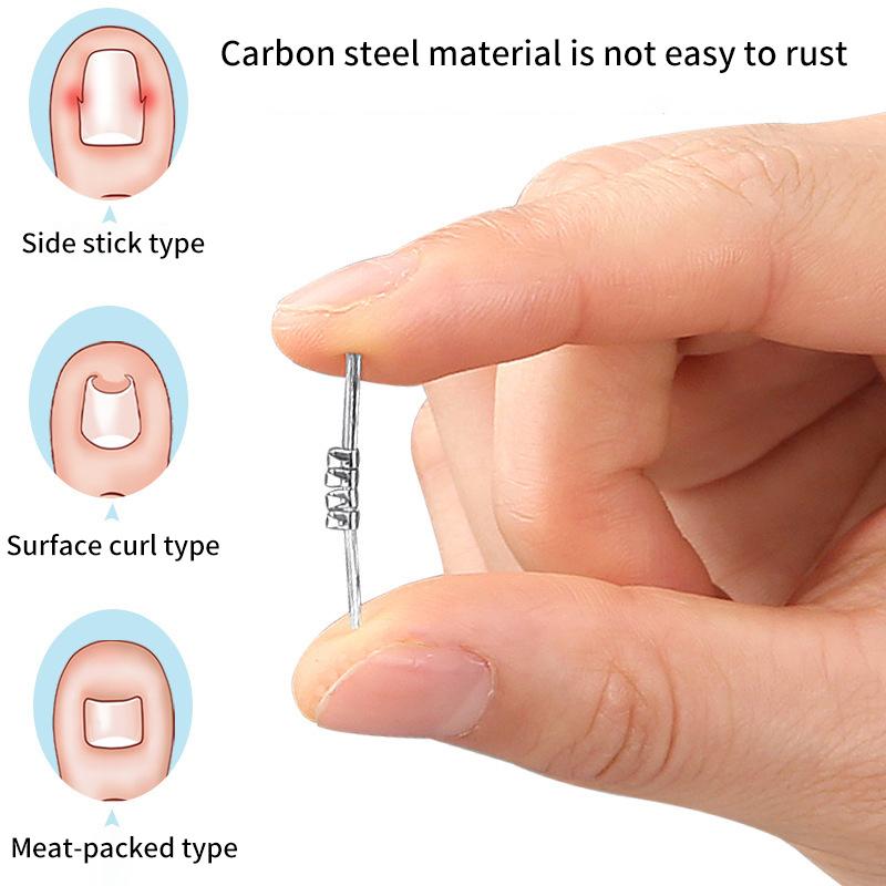 1 шт. Устройство для коррекции вросшего ногтя – Невидимый эластичный выпрямляющий зажим для выравнивания ногтя и ухода за педикюром