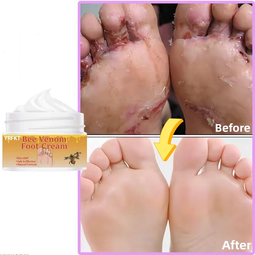 Bee Venom Foot Cream Deeply Cleanses the Feet, Prevents Dryness and Cracking, Effectively Moisturizes Dry Skin, and Prevents Peeling.