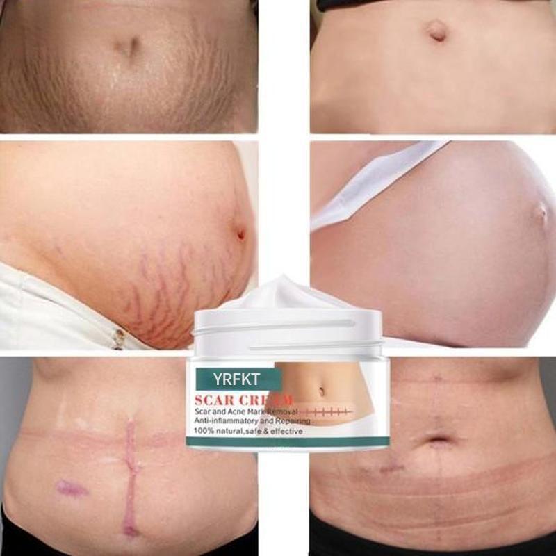 Глубоко проникающий крем для ухода за кожей кутикулы, прыщей, растяжек и шрамов