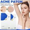 Пластырь от прыщей и прыщей, наклейка для лица и кожи