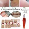 6 Pcs/set Foot Corn Removal Killer Calluses Plantar