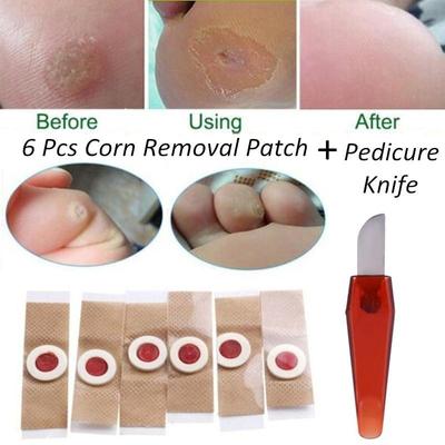 6 шт./компл. для удаления мозолей на ногах, подошвенных мозолей