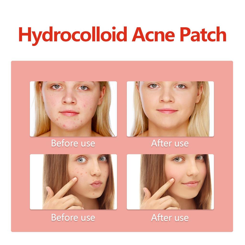 EELHOE Пластырь от прыщей Colorful Acne Patch мягко и не вызывает раздражения, осветляет прыщи и улучшает состояние кожи, склонной к акне.