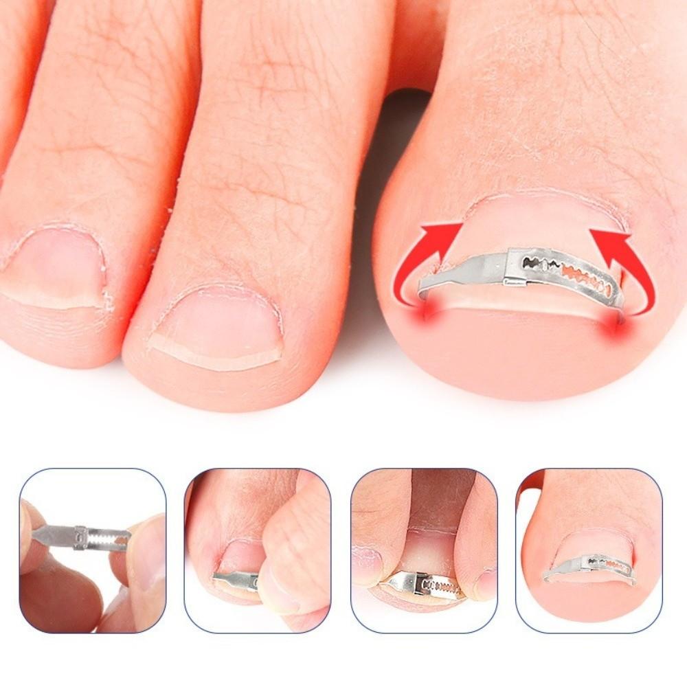 2PCS Adjustable Ingrown Toenail Treatment Stainless Curved Toenail Repair Tool Home Foot Care