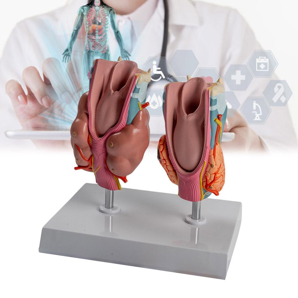 Патологическая анатомическая модель щитовидной железы со съемными частями Патологическая анатомическая модель щитовидной железы и гортани для изучения заболеваний