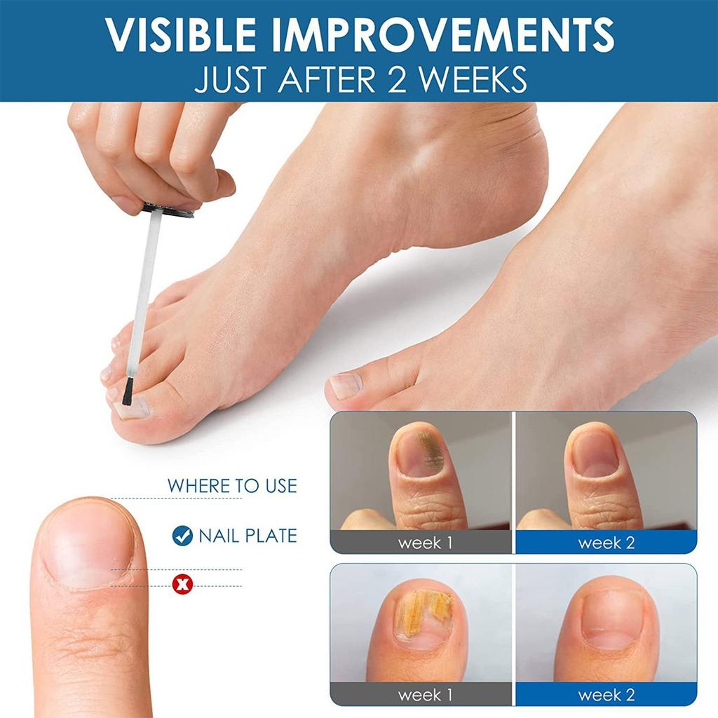 Powerful Nail Serum, Nail Care Fast & Advanced For Healthy Nails & Toenails, 20ml