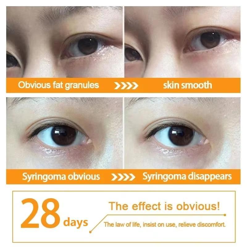 Крем для кожи вокруг глаз, удаляющий жировые гранулы, противовоспалительный, уменьшающий темные круги, разглаживающий мелкие морщины, восстанавливающий барьерный крем