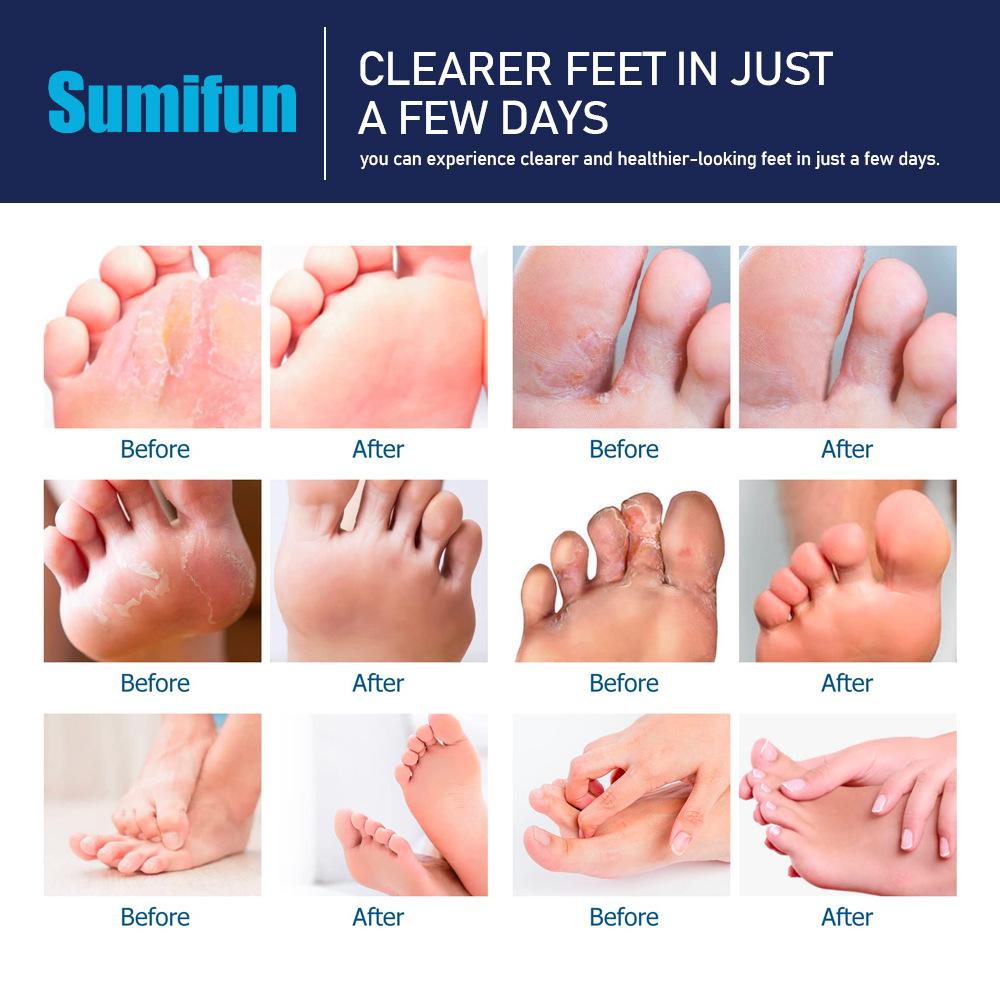 2 шт./компл. крем для ног бери-бери для ног, удаляющий запах пота, мазь для ног, снимающий зуд ног, спрей-крем
