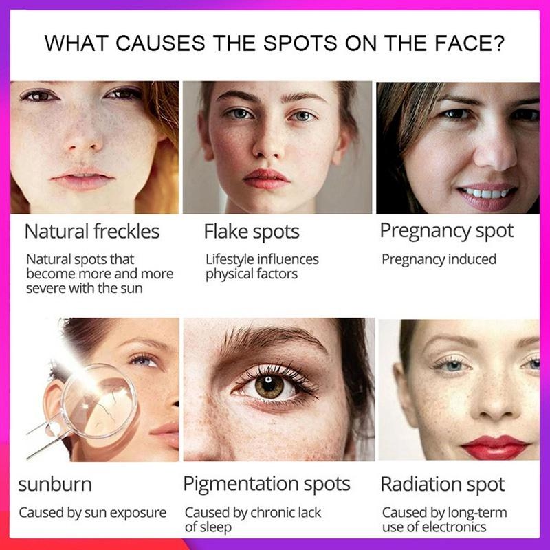 Новейший крем-корректор темных пятен, отбеливающий крем для лица, ремонт, выцветание веснушек, удаление темных пятен, средство для удаления меланина, осветляющий крем для лица